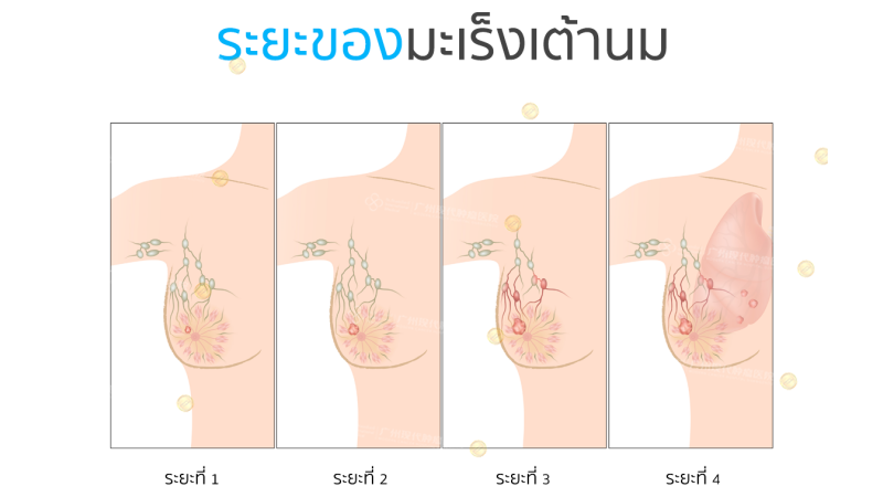 ระยะของมะเร็งเต้านม