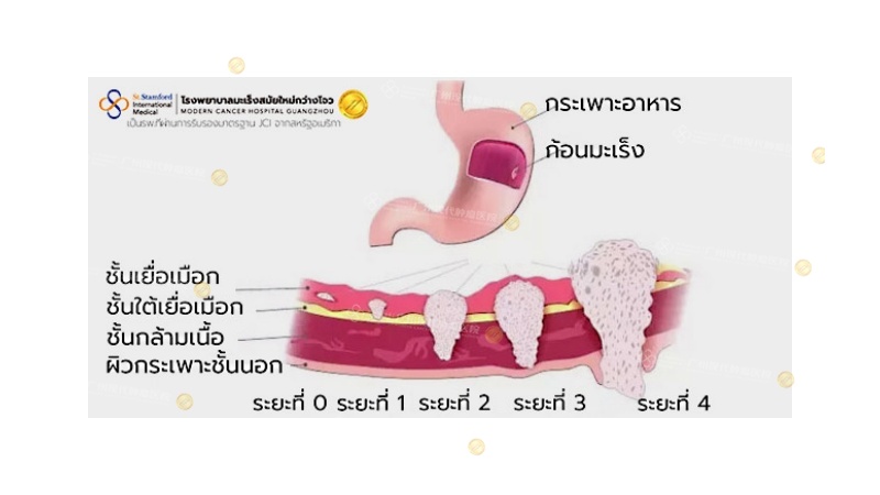 ระยะของมะเร็งกระเพาะอาหาร