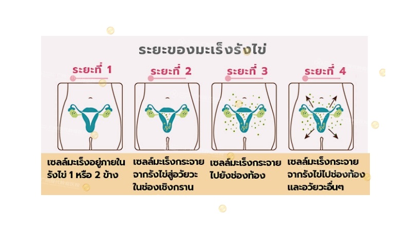 ระยะของมะเร็งรังไข่