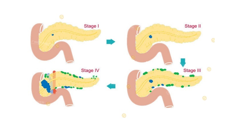 胰腺癌_副本.jpg