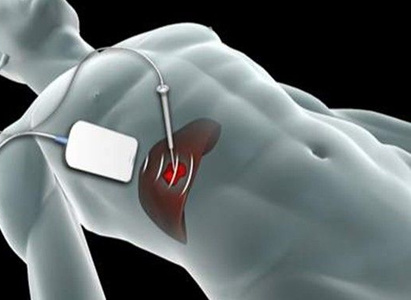 Microwave ablation (MWA), cancer, cancer treatment, Modern Cancer Hospital Guangzhou, minimally invasive treatment, cancer symptoms, cancer diagnosis